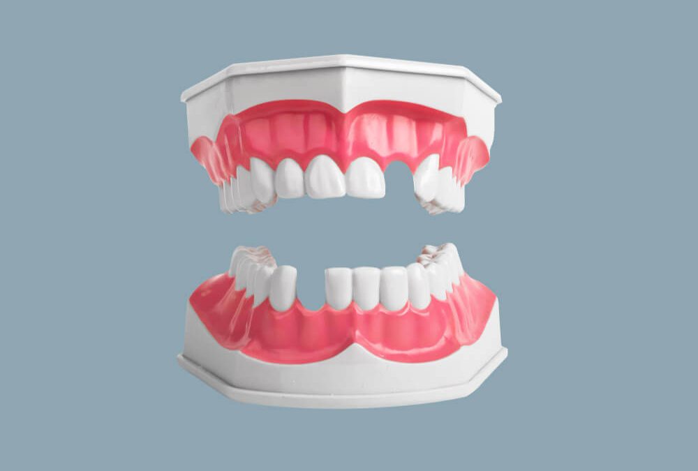 Aplicación del Escáner e Impresoras 3D a la Odontología Moderna