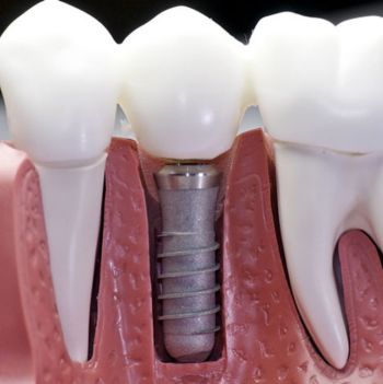 implante dental madrid pinar de chamartin madriddental