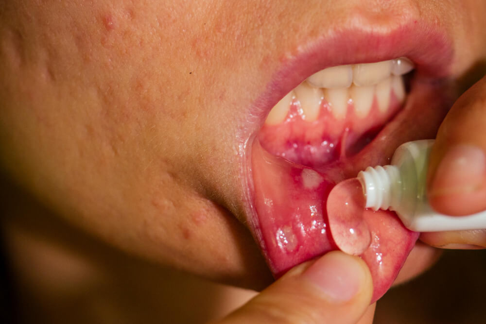 sintomas diabetes higiene madrid dental blog